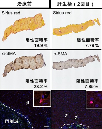 図2　非発がん群のコラーゲン量とαSMAの変化、<br />およびCYGBとαSMAの発現<br />赤：CYGB 緑：αSMA 青：核